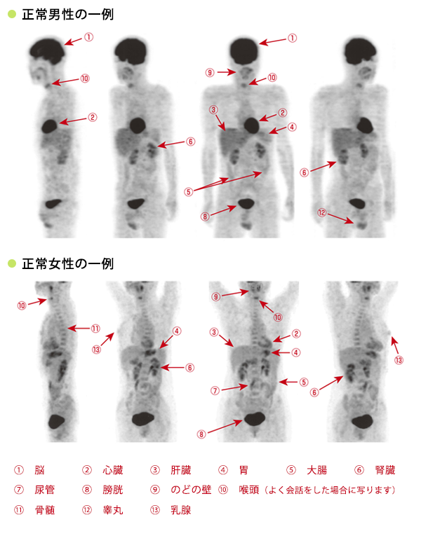 FDG-PET検査とはの画像