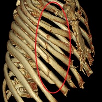 ↑広範囲における骨折も容易に描出できます。