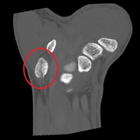 豆状骨骨折(コロナル断面像)