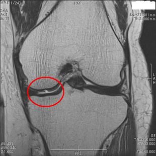 骨軟骨剥離　T２強調