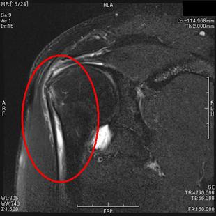 上腕二頭筋長頭腱損傷疑　T２強調脂肪抑制