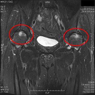 変形性股関節症　T２強調脂肪抑制