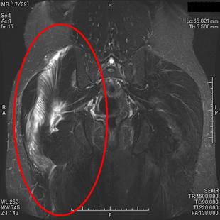 大臀筋損傷　T２強調脂肪抑制