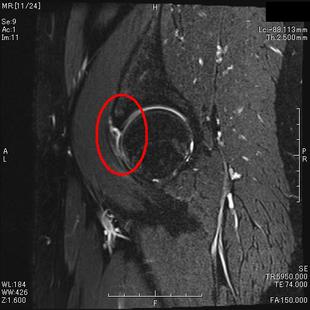 関節唇損傷（斜矢状断）