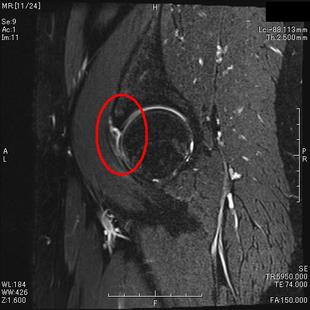 関節のMRI 足関節MRI画像正常解剖ツール！3方向！苦手な人もこれで大丈夫！