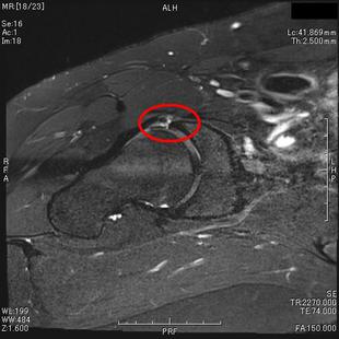 関節唇損傷(ラジアルイメージング)