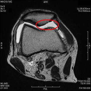 骨軟骨剥離　T２強調