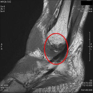 ATFL(前距腓靱帯)による裂離骨折　T１強調