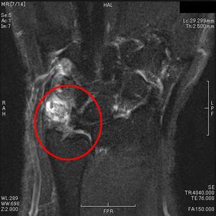 TFCC損傷　T２強調脂肪抑制