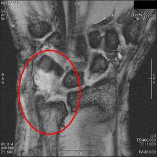 TFCC損傷　T2＊強調