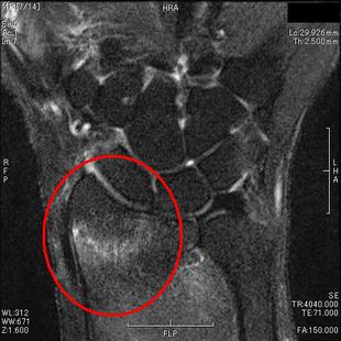 橈骨骨折　T２強調脂肪抑制