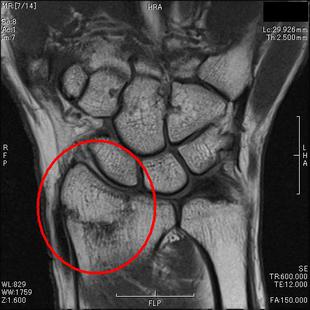 橈骨骨折　T１強調