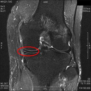 半月板損傷　T２強調脂肪抑制
