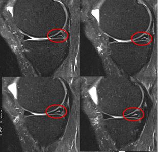 半月板損傷　T２強調脂肪抑制