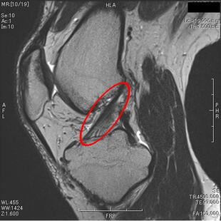 前十字靱帯（正常）T２強調