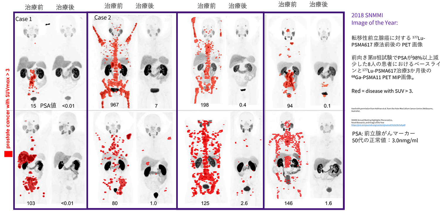 放射性リガンド療法（Radio Ligand Therapy）とは？