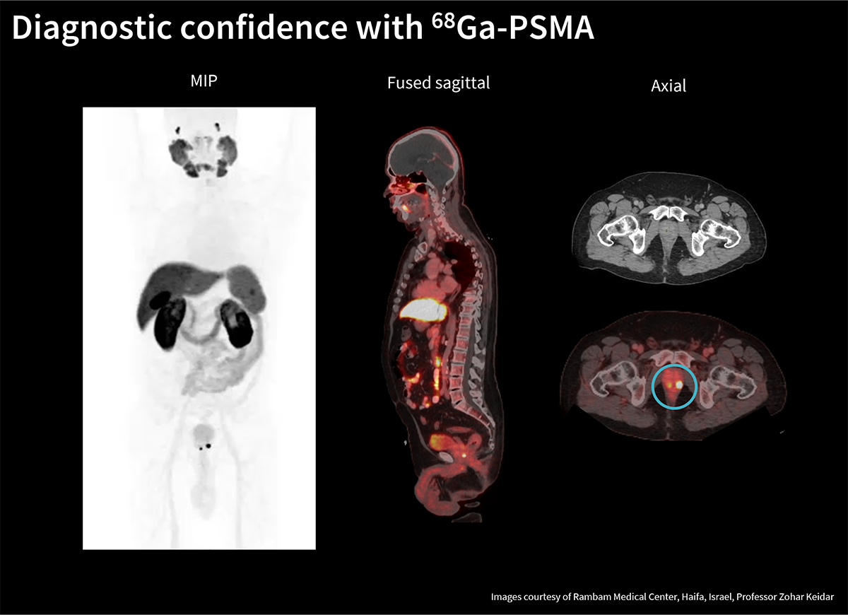 PSMA-PET薬剤について